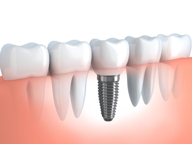 Dental Implants  Wickenburg, AZ 
